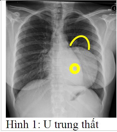 Phẫu thuật và điều trị khối U trung thất
